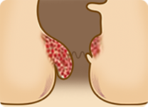 치핵 2기 — 치핵이 커져 항문 입구 가까이 내려온 단면 도해