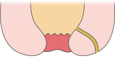 치루 — 항문샘 염증으로 생긴 고름 길이 항문 바깥 피부로 이어진 모습 도해